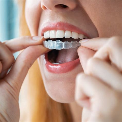 Magical teeth aligner for an instant smile makeover